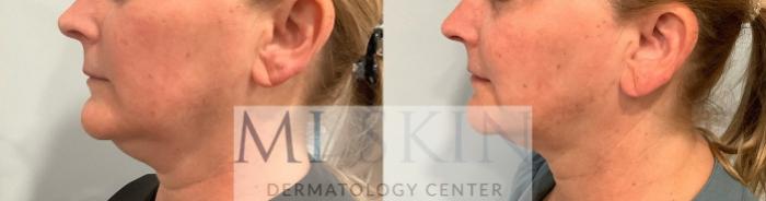 Before & After Laser Skin Tightening Case 63 Left Side View in Washington, DC
