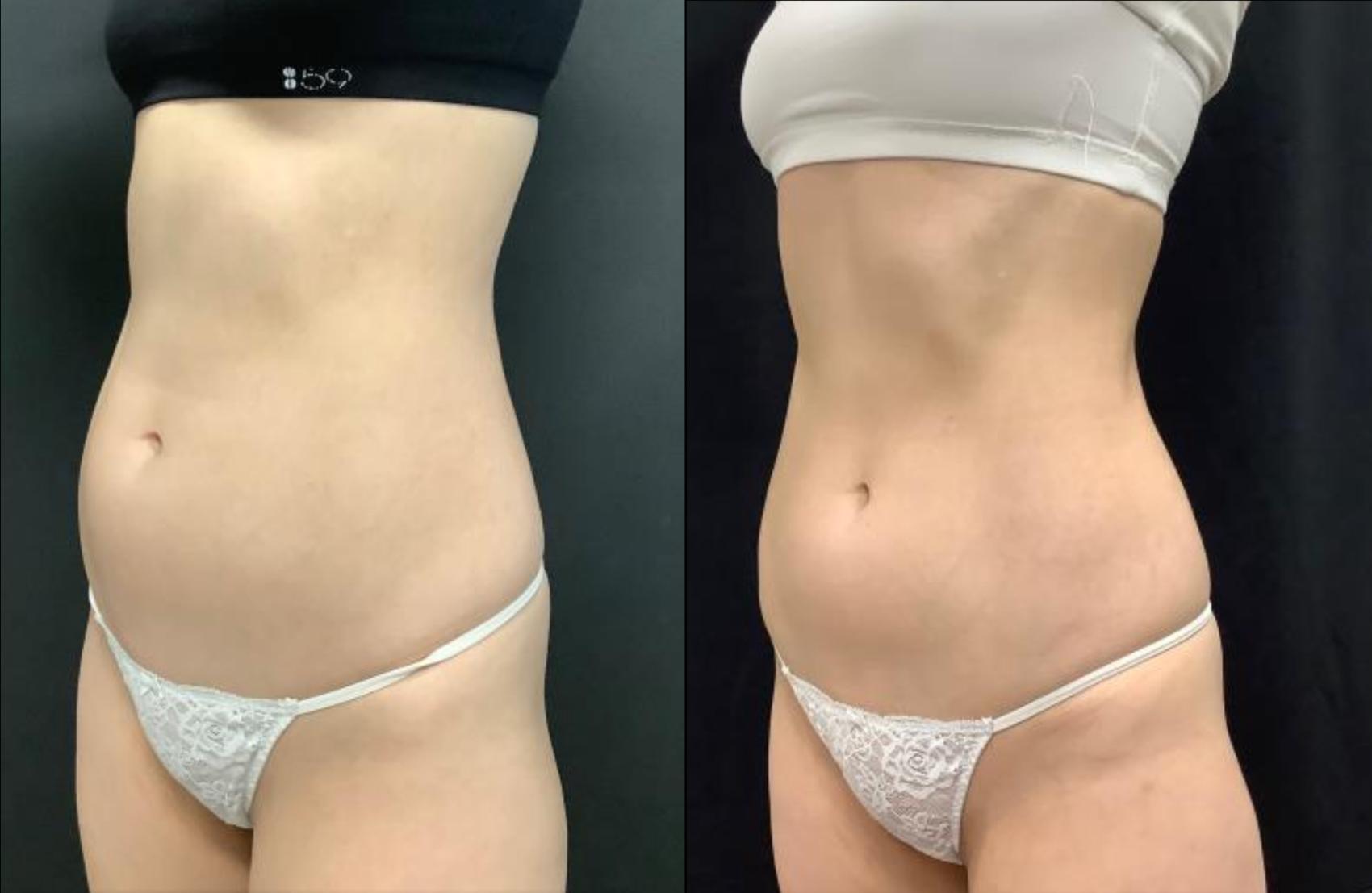 Before & After Accufit Case 27 Left Oblique View in Washington, DC