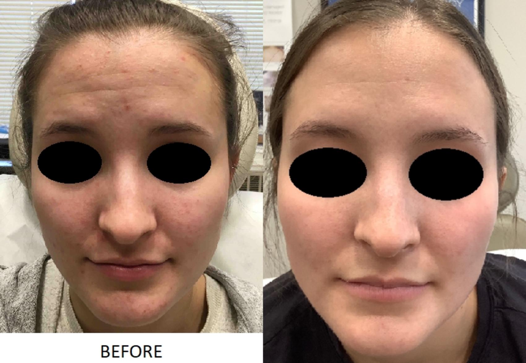 Bbl Before And After Photos Patient 14 Washington Dc Mi Skin Dermatology Center Melda Isaac Md 