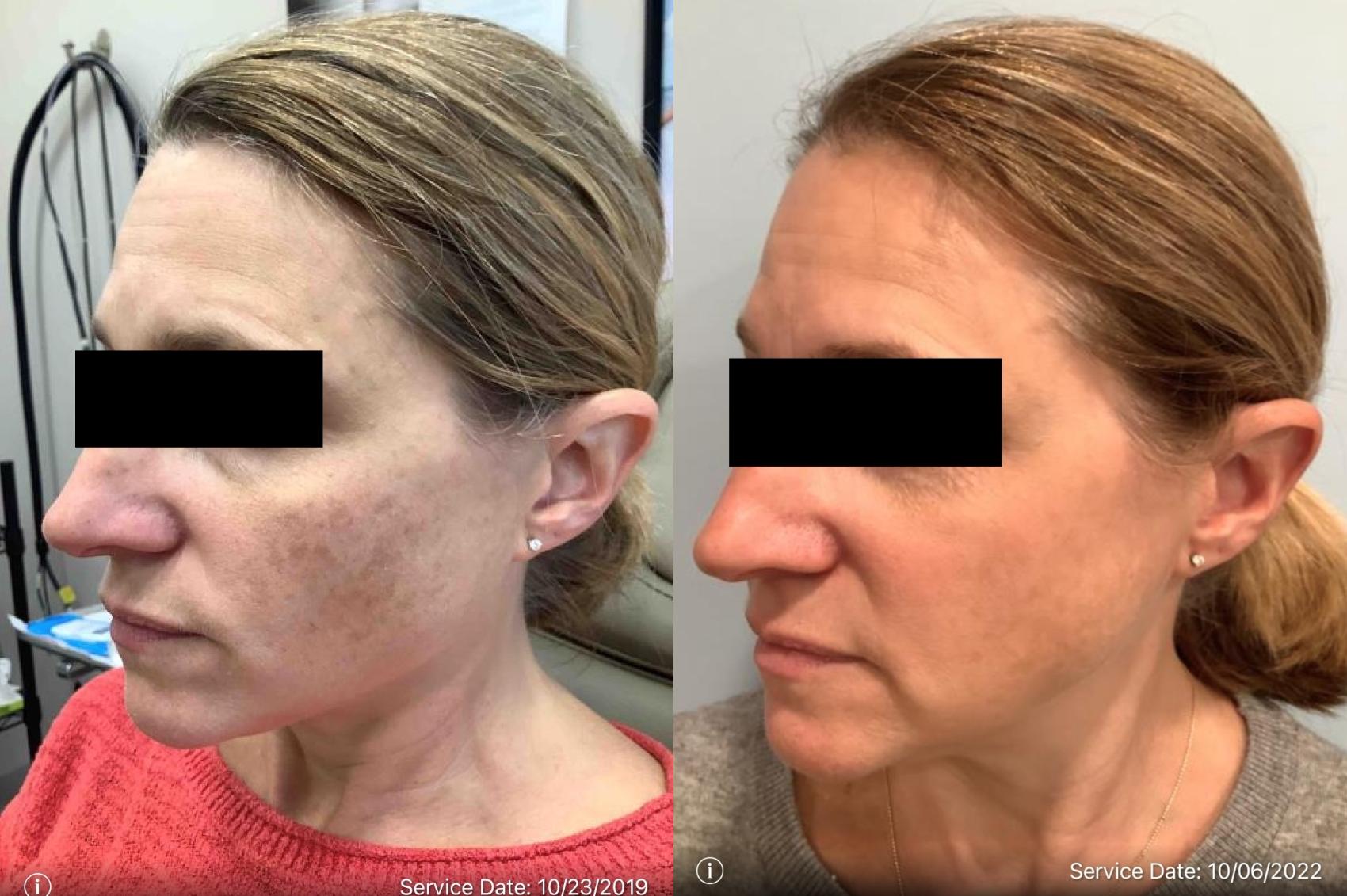 BBL Before After Photos Patient 45 Washington DC MI Skin 