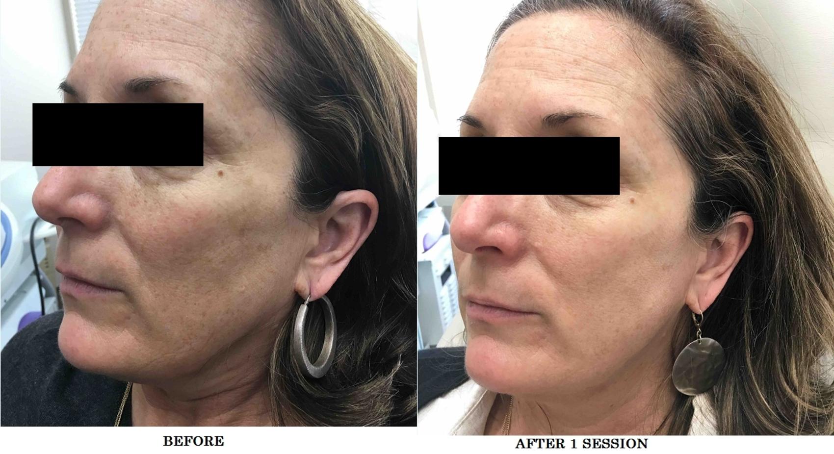BBL Case 9 Before & After Left Oblique | Washington, DC | MI Skin Dermatology Center: Melda Isaac, MD