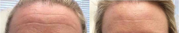 Before & After Microneedling Case 6 Front View in Washington, DC