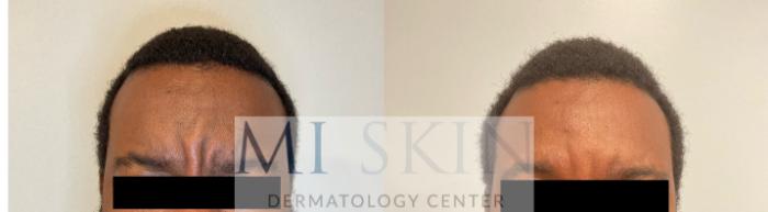 Before & After Botox Case 61 Front View in Washington, DC
