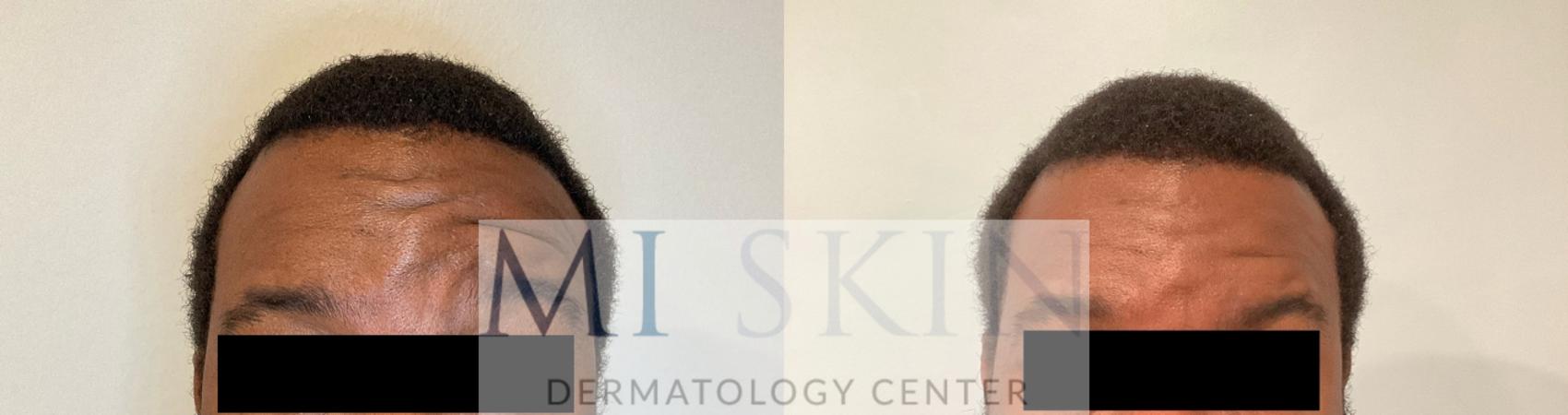 Before & After Botox Case 62 Front View in Washington, DC