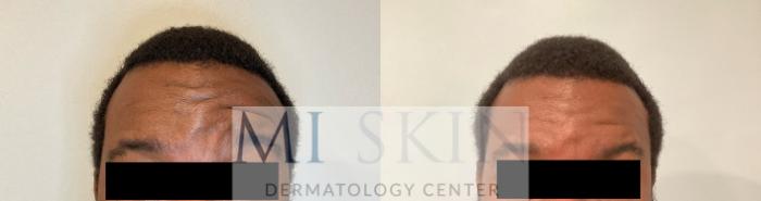 Before & After Botox Case 62 Front View in Washington, DC