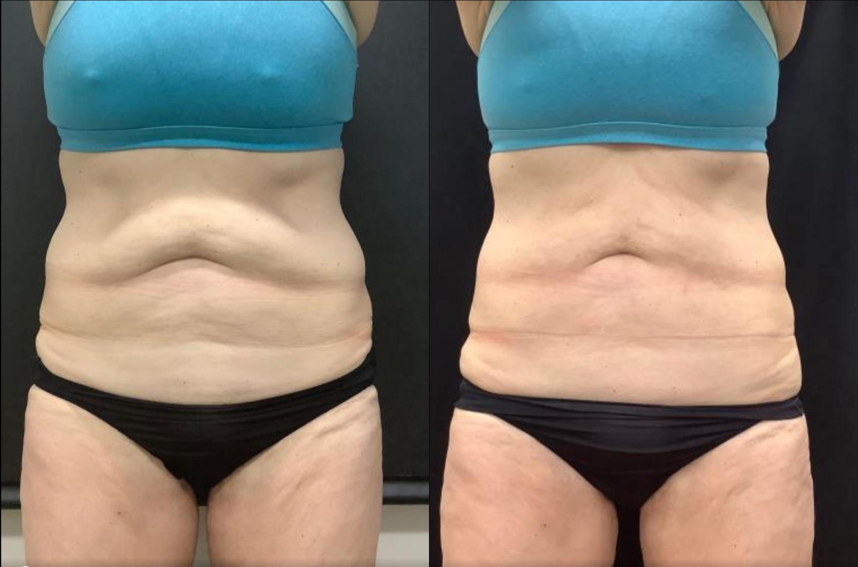 Before & After CoolSculpting Case 30 Front View in Washington, DC