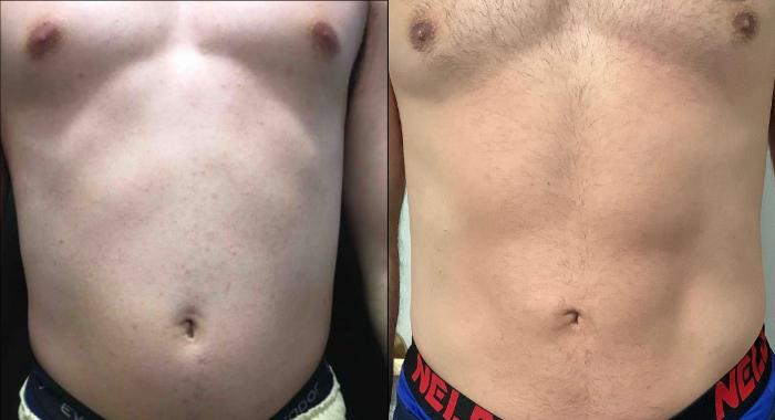 Before & After CoolSculpting Case 31 Front View in Washington, DC