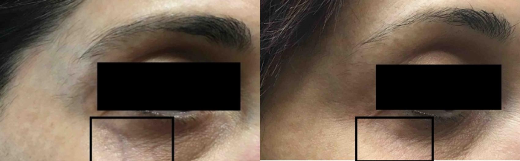 Cutera Laser Case 16 Before & After Left Side | Washington, DC | MI Skin Dermatology Center: Melda Isaac, MD