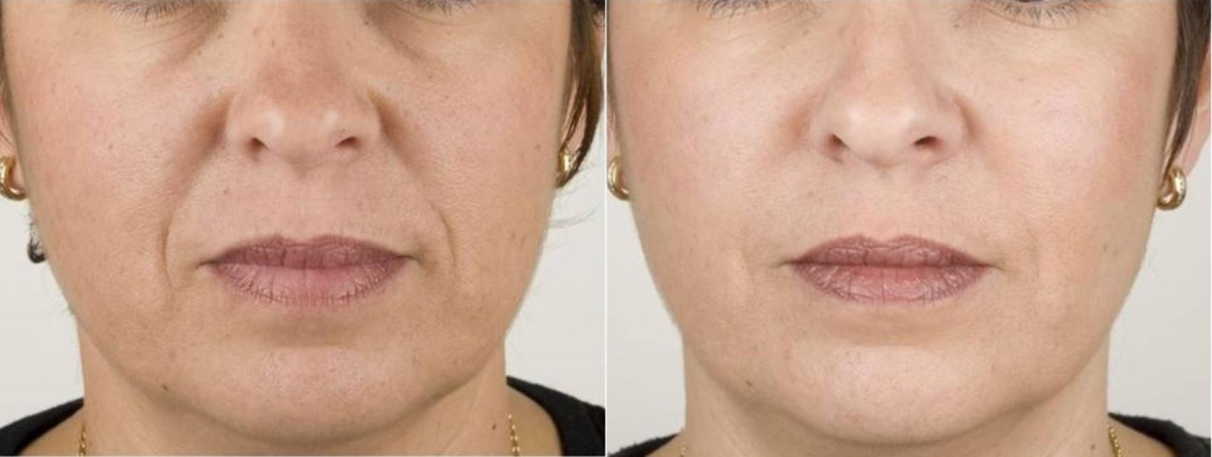 Dermal Fillers Case 22 Before & After Front | Washington, DC | MI Skin Dermatology Center: Melda Isaac, MD