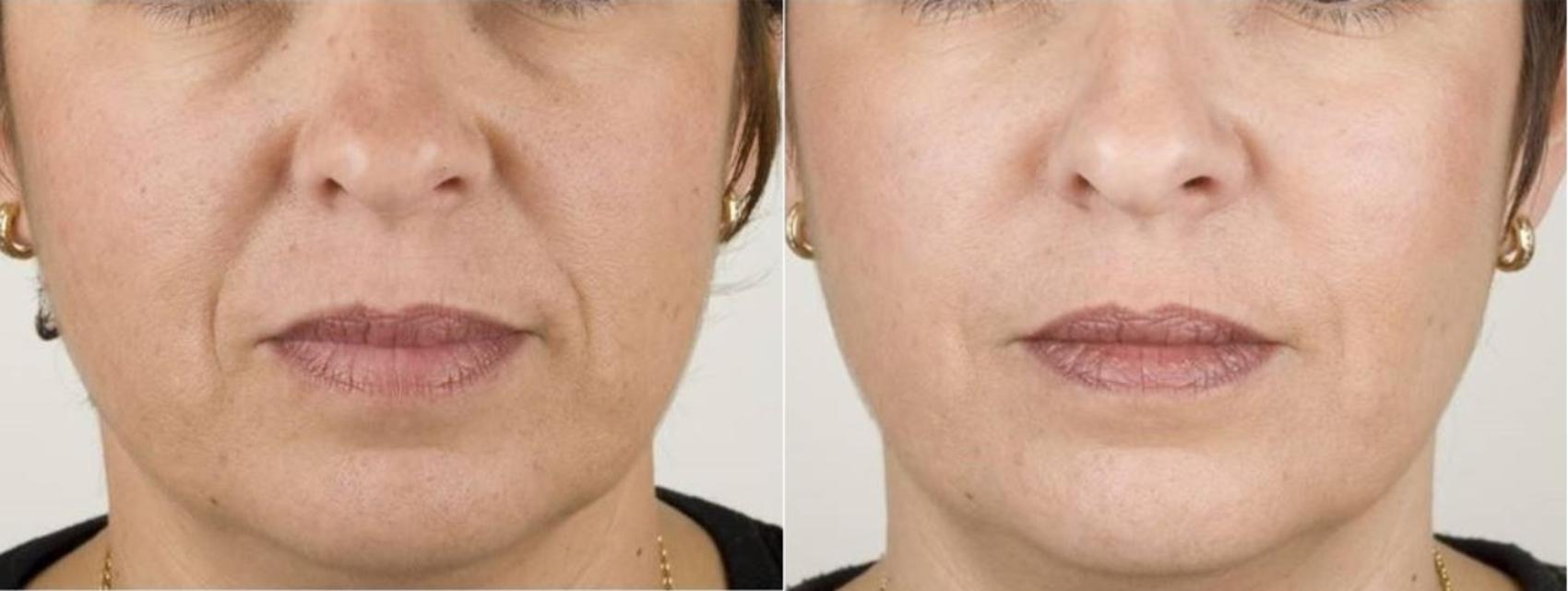 Before & After Dermal Fillers Case 22 Front View in Washington, DC