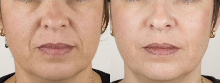 Before & After Dermal Fillers Case 22 Front View in Washington, DC