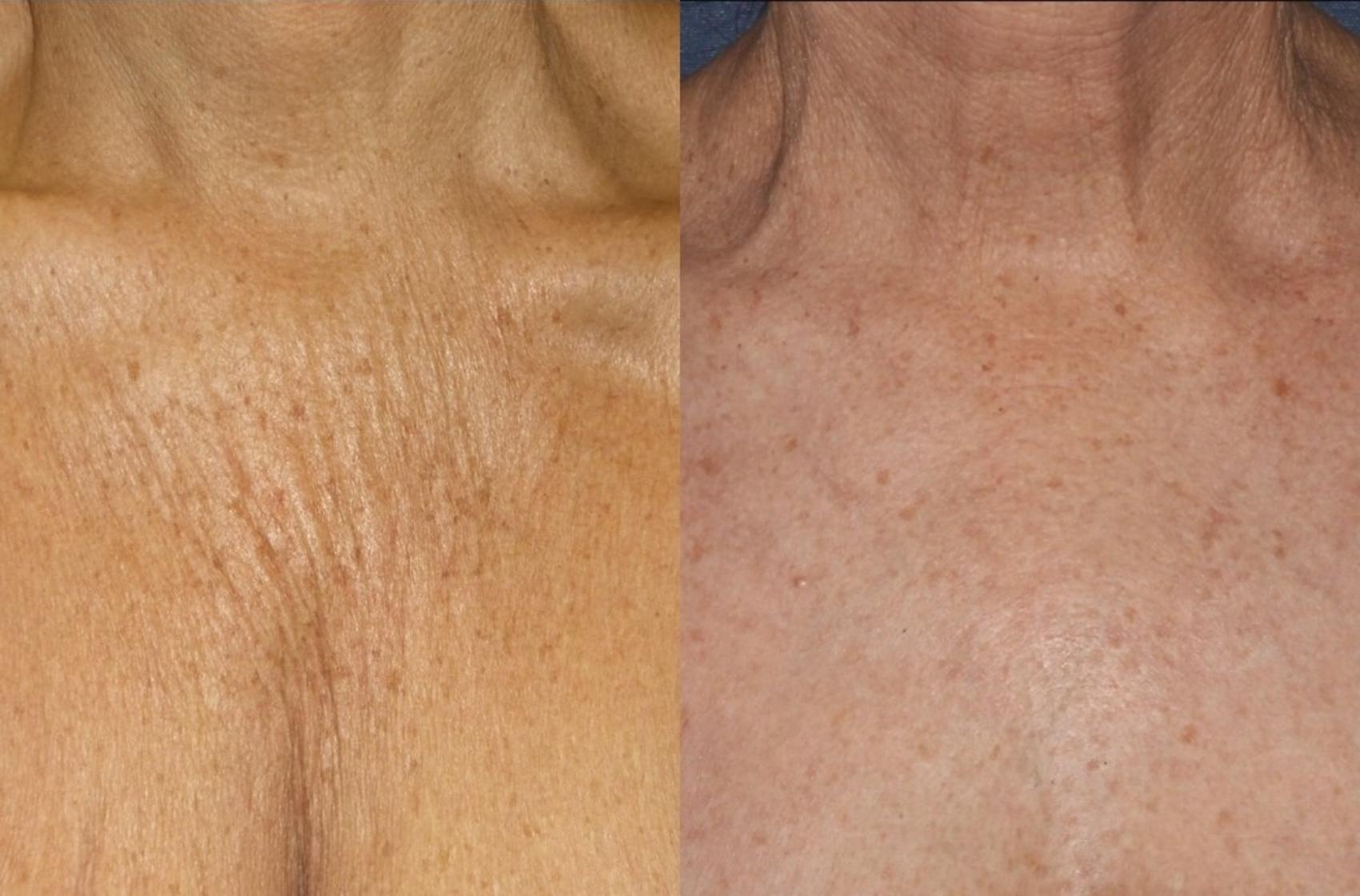 Before & After Dermal Fillers Case 23 Front View in Washington, DC