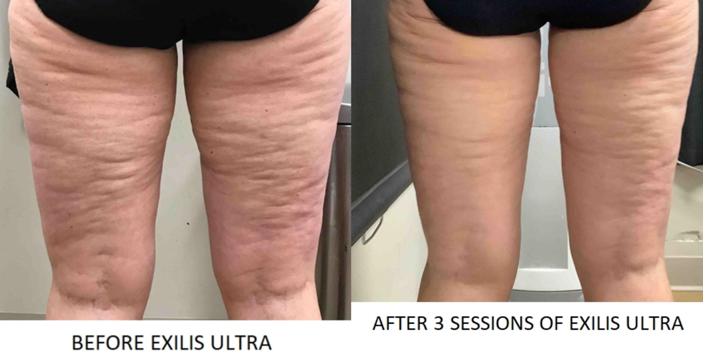 Exilis Ultra Skin Tightening Case 11 Before & After Back | Washington, DC | MI Skin Dermatology Center: Melda Isaac, MD