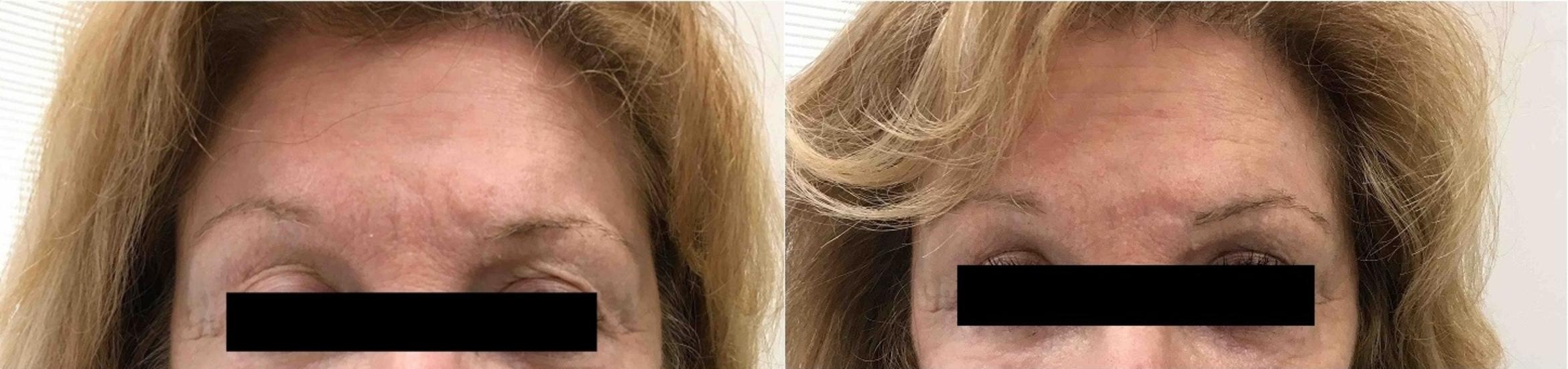 Exilis Ultra Skin Tightening Case 17 Before & After Front | Washington, DC | MI Skin Dermatology Center: Melda Isaac, MD