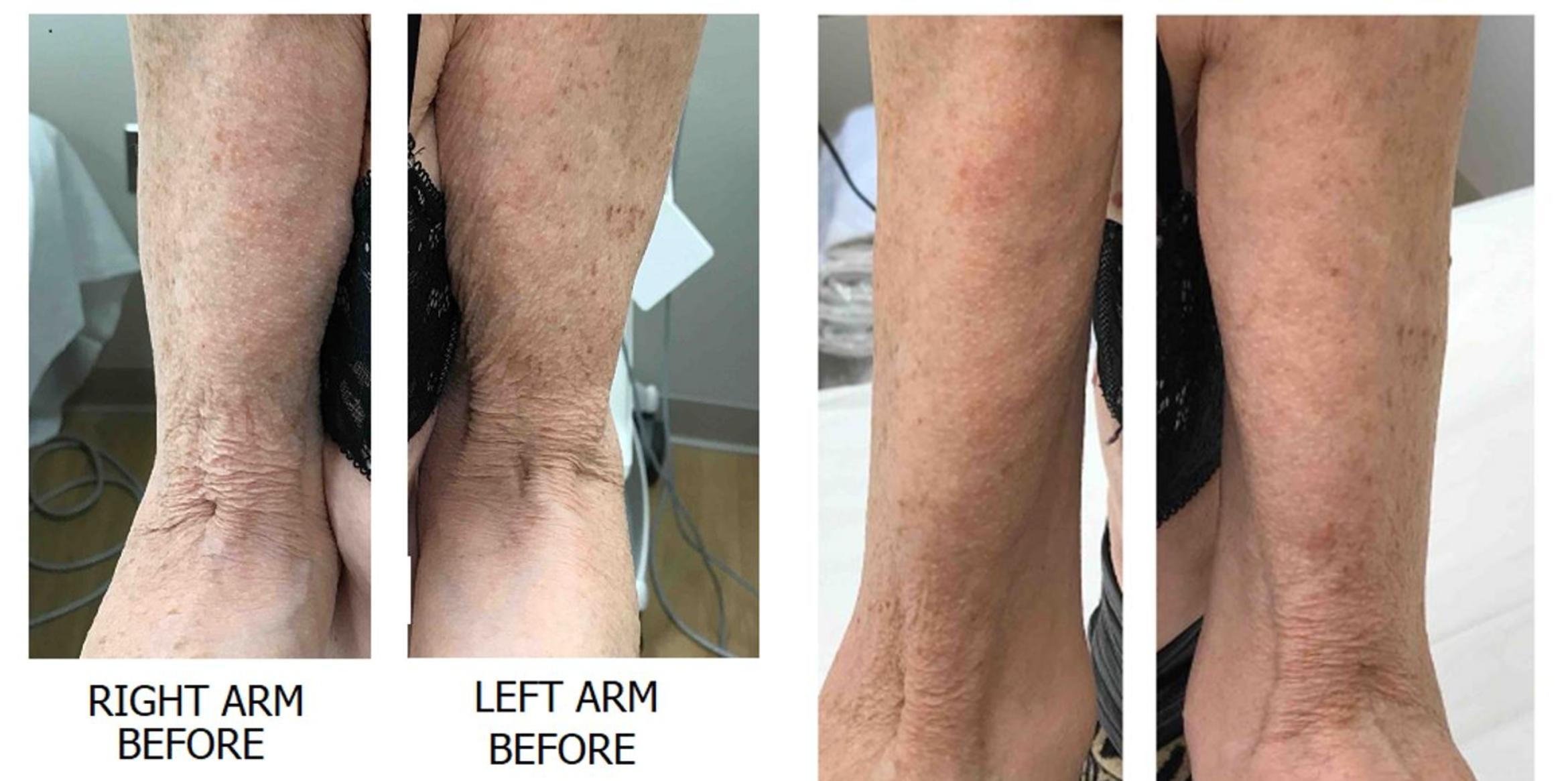Exilis Ultra Skin Tightening Case 7 Before & After Front | Washington, DC | MI Skin Dermatology Center: Melda Isaac, MD