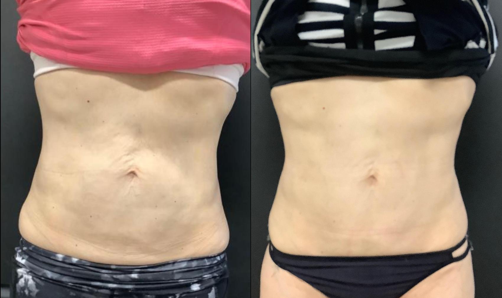 Before & After Exilis Ultra Skin Tightening Case 34 Front View in Washington, DC