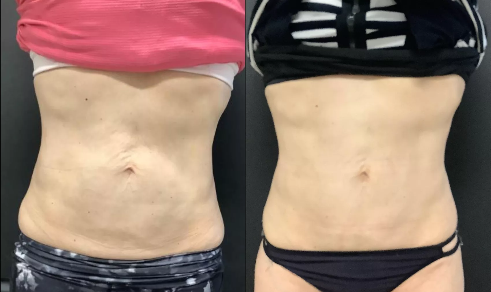 Exilis Ultra Skin Tightening Before & After Photos Patient 34, Washington,  DC