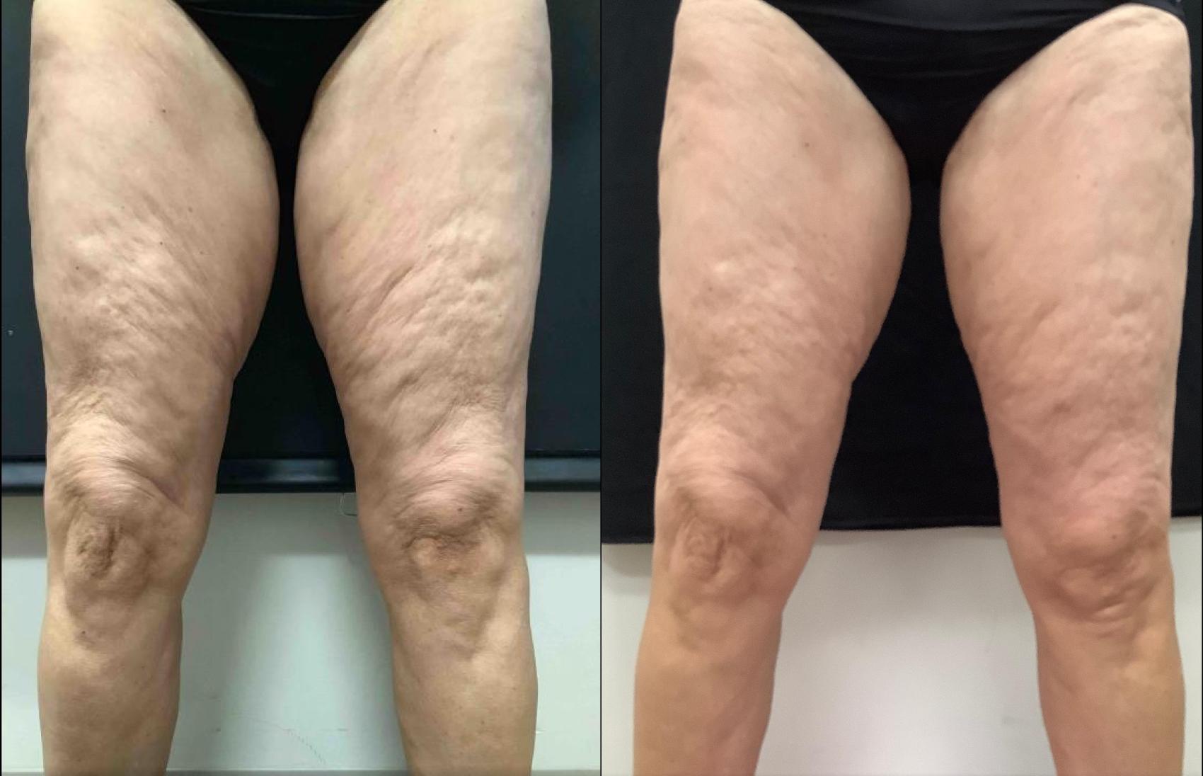 Exilis Ultra Skin Tightening Case 35 Before & After Front | Washington, DC | MI Skin Dermatology Center: Melda Isaac, MD