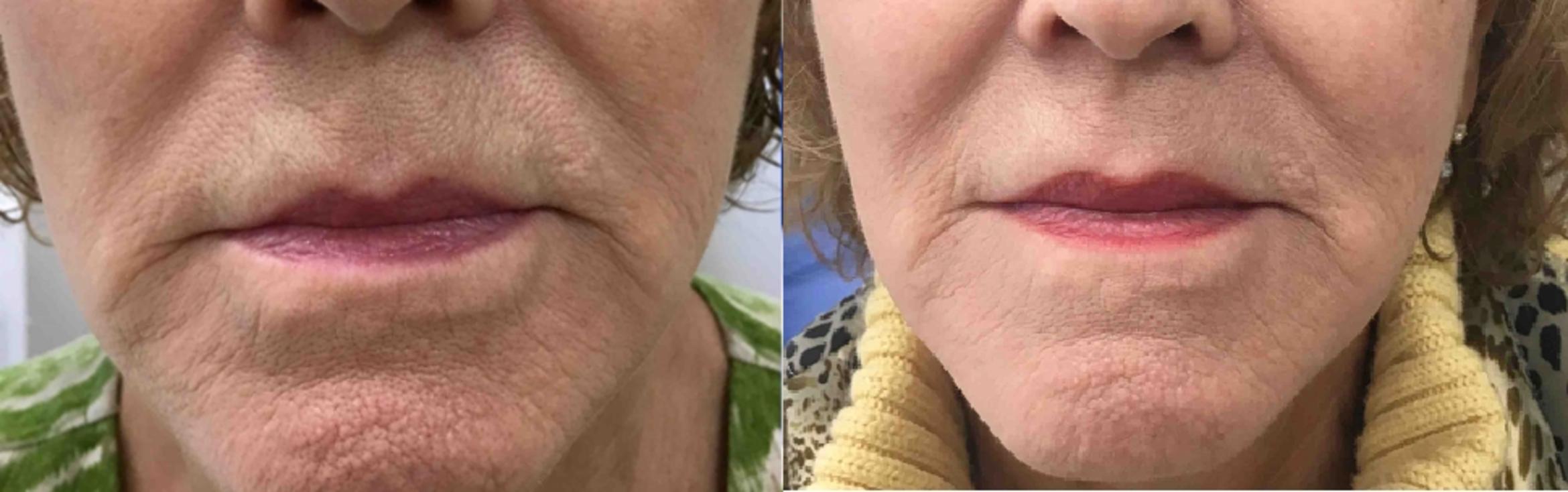 Before & After Genius RF Microneedling Case 12 Front View in Washington, DC
