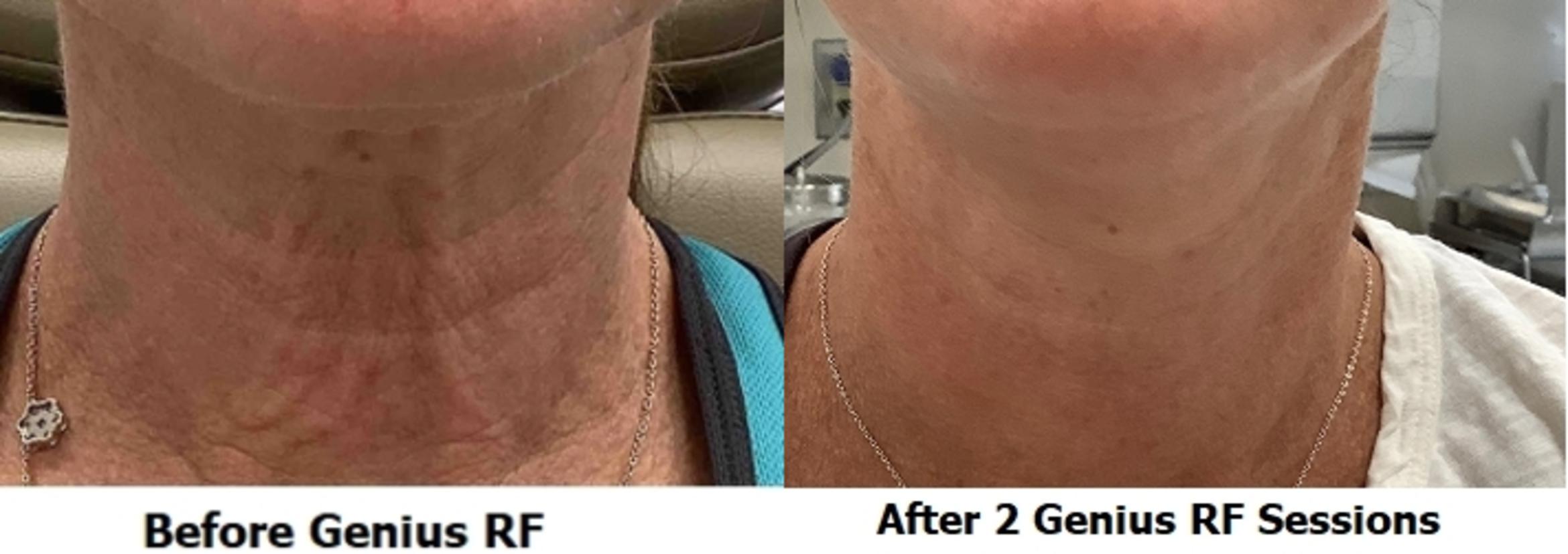 Before & After Genius RF Microneedling Case 18 Front View in Washington, DC