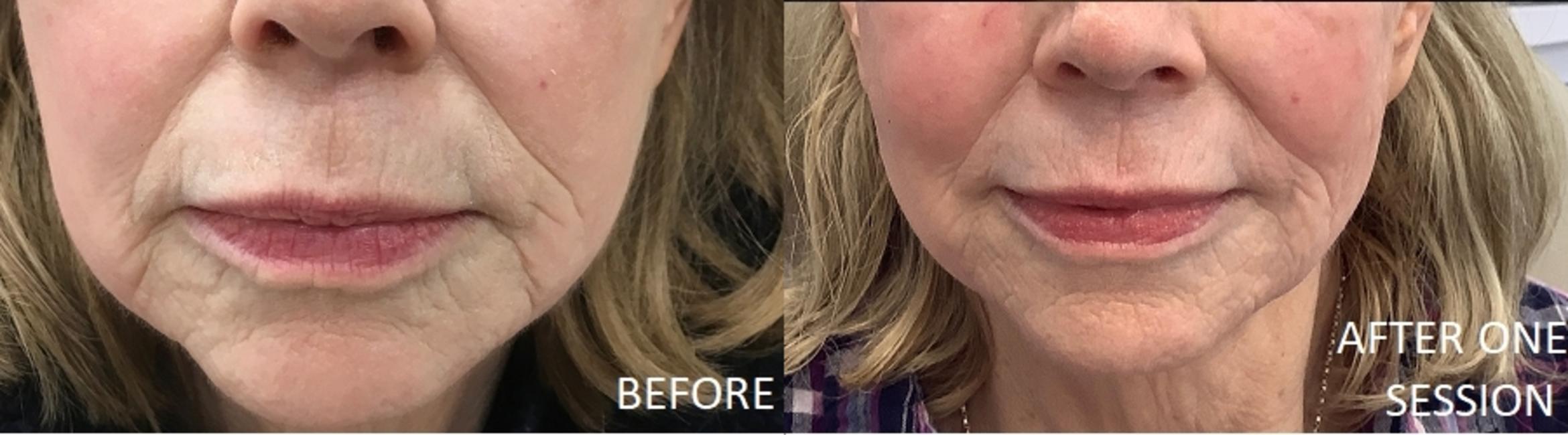Before & After Genius RF Microneedling Case 19 Front View in Washington, DC