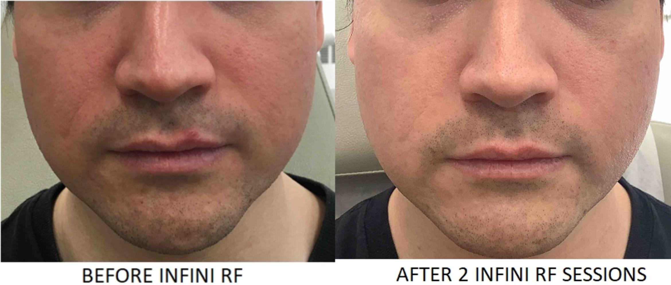 Before & After Genius RF Microneedling Case 20 Front View in Washington, DC