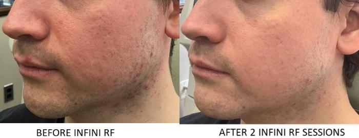 Before & After Genius RF Microneedling Case 20 Left Side View in Washington, DC