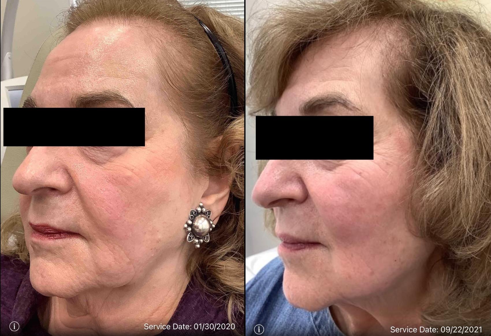 Before & After Genius RF Microneedling Case 42 Left Oblique View in Washington, DC