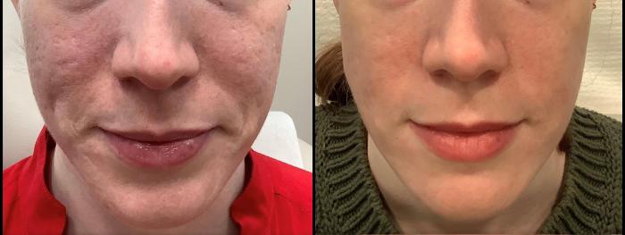 RF Microneedling before and after