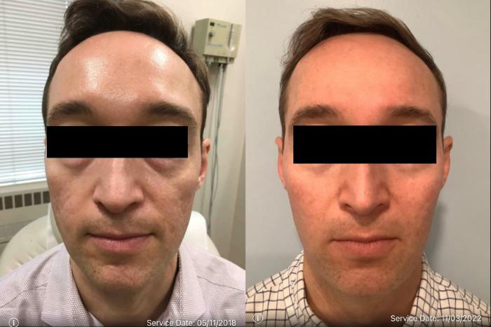 Before & After Genius RF Microneedling Case 46 Front View in Washington, DC