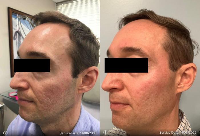 Before & After Genius RF Microneedling Case 47 Left Oblique View in Washington, DC