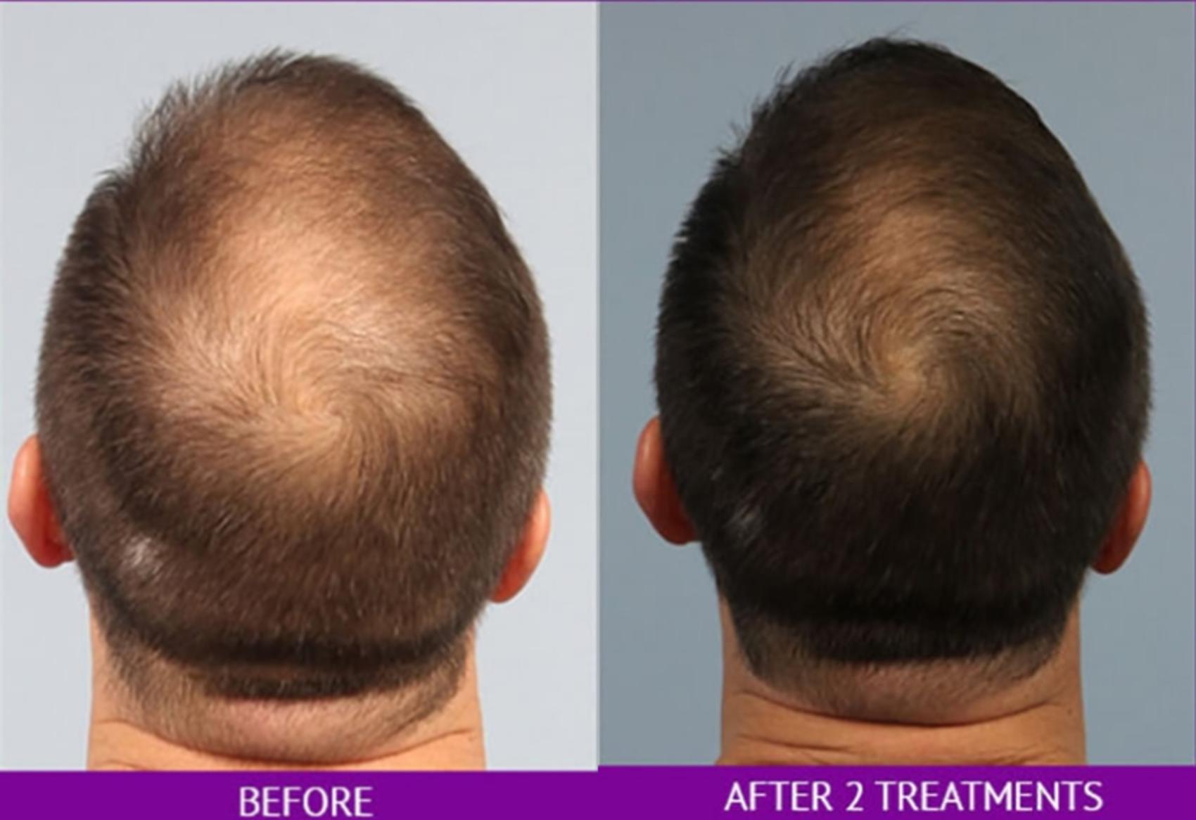 Before & After Hair Restoration Case 24 Back View in Washington, DC