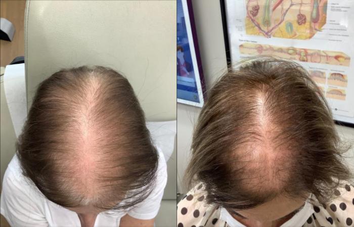 Before & After Keralase Hair Restoration Case 37 Top of Head View in Washington, DC