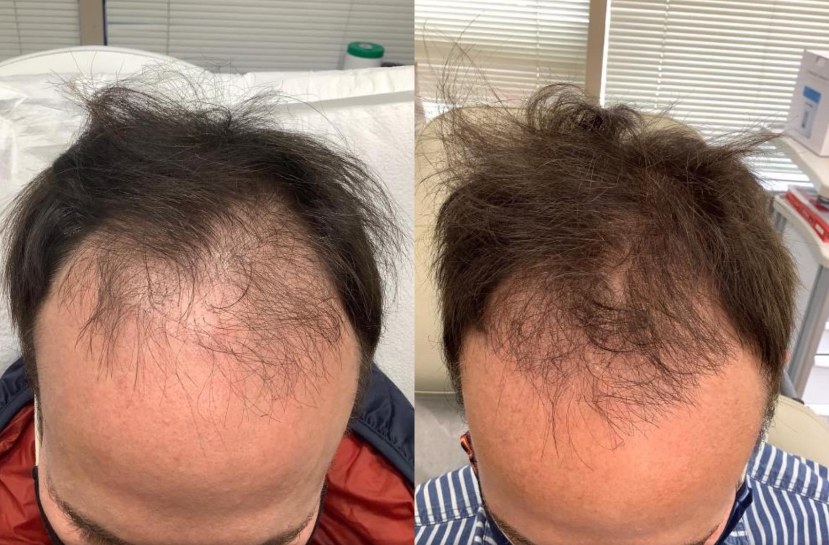 Before & After Hair Restoration Case 40 Front View in Washington, DC