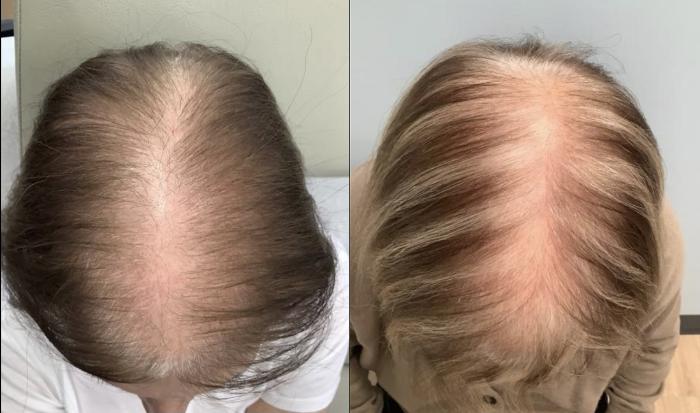 Before & After Hair Restoration Case 49 Top of Head Center Part View in Washington, DC