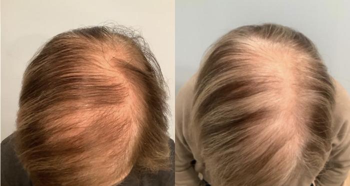Before & After Hair Restoration Case 49 Top of Head Side Part View in Washington, DC