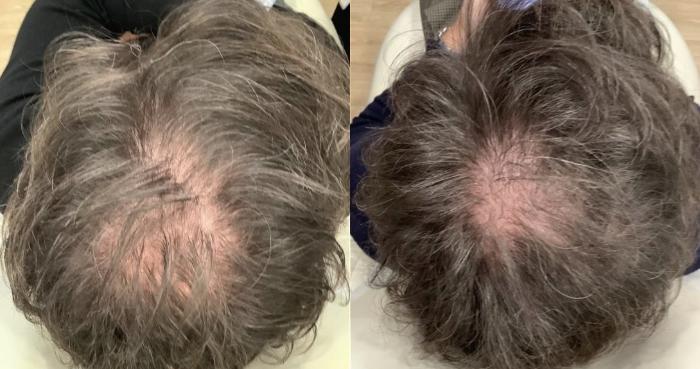 Before & After Hair Restoration Case 50 Top of Head View in Washington, DC