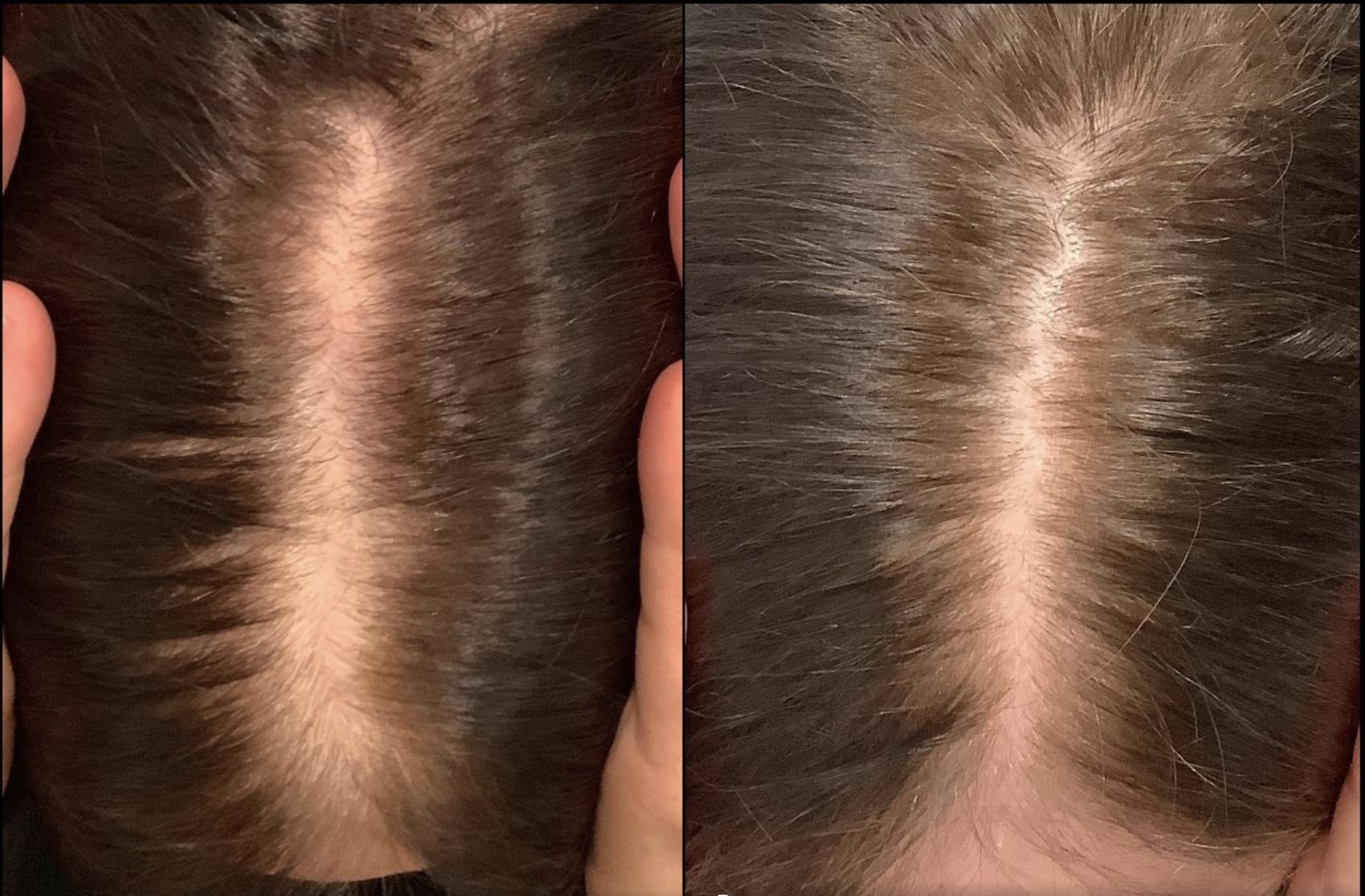 Before & After Hair Restoration Case 51 Top of Head View in Washington, DC
