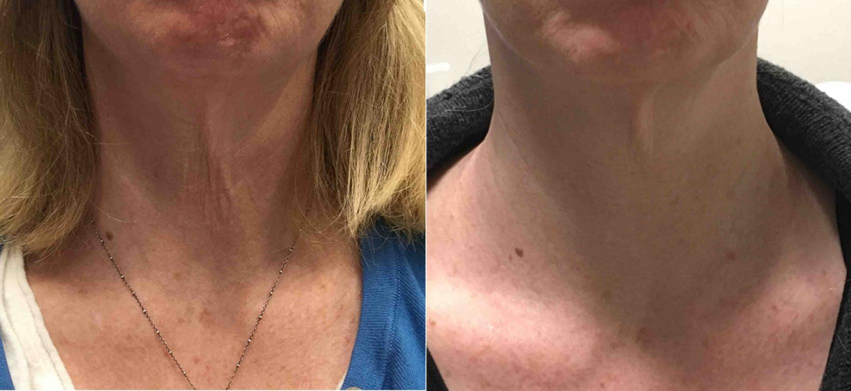 Laser Skin Tightening Case 25 Before & After Front | Washington, DC | MI Skin Dermatology Center: Melda Isaac, MD