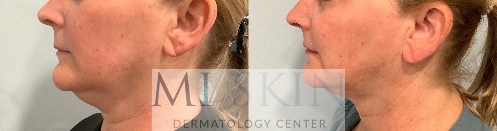 Before & After Laser Skin Tightening Case 63 Left Side View in Washington, DC