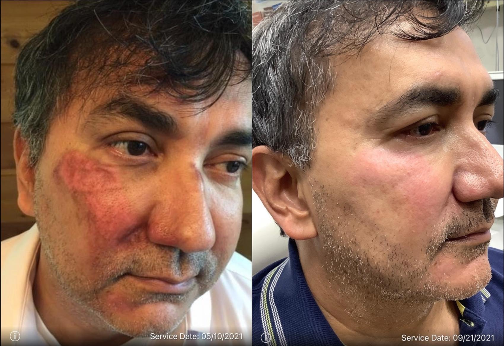Laser Treatment of Scars Case 41 Before & After Right Oblique | Washington, DC | MI Skin Dermatology Center: Melda Isaac, MD