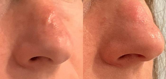 Before & After Laser Treatment of Scars Case 54 Right Oblique View in Washington, DC