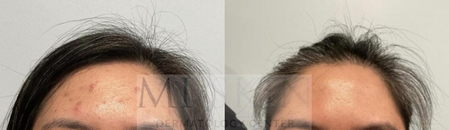 Before & After Laser Treatment of Scars Case 58 Front View in Washington, DC