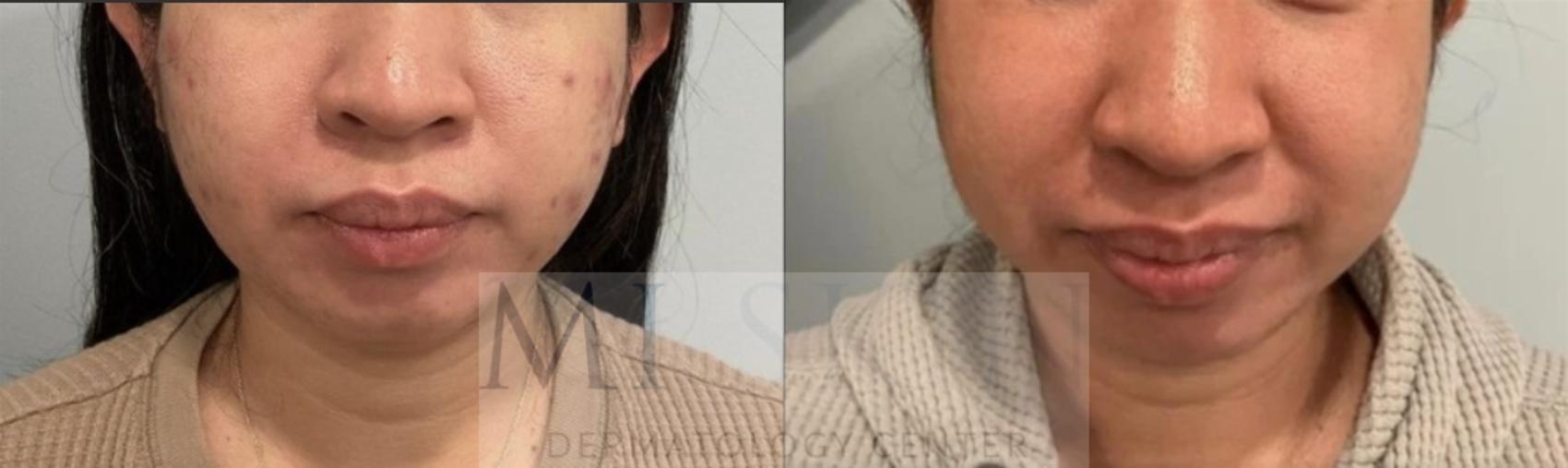 Before & After Laser Treatment of Scars Case 59 Front View in Washington, DC