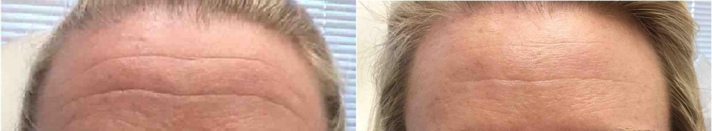 Microneedling Case 6 Before & After Front | Washington, DC | MI Skin Dermatology Center: Melda Isaac, MD