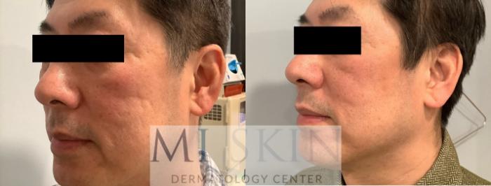 Before & After Non-Ablative Skin Rejuvenation  Case 60 Left Side View in Washington, DC