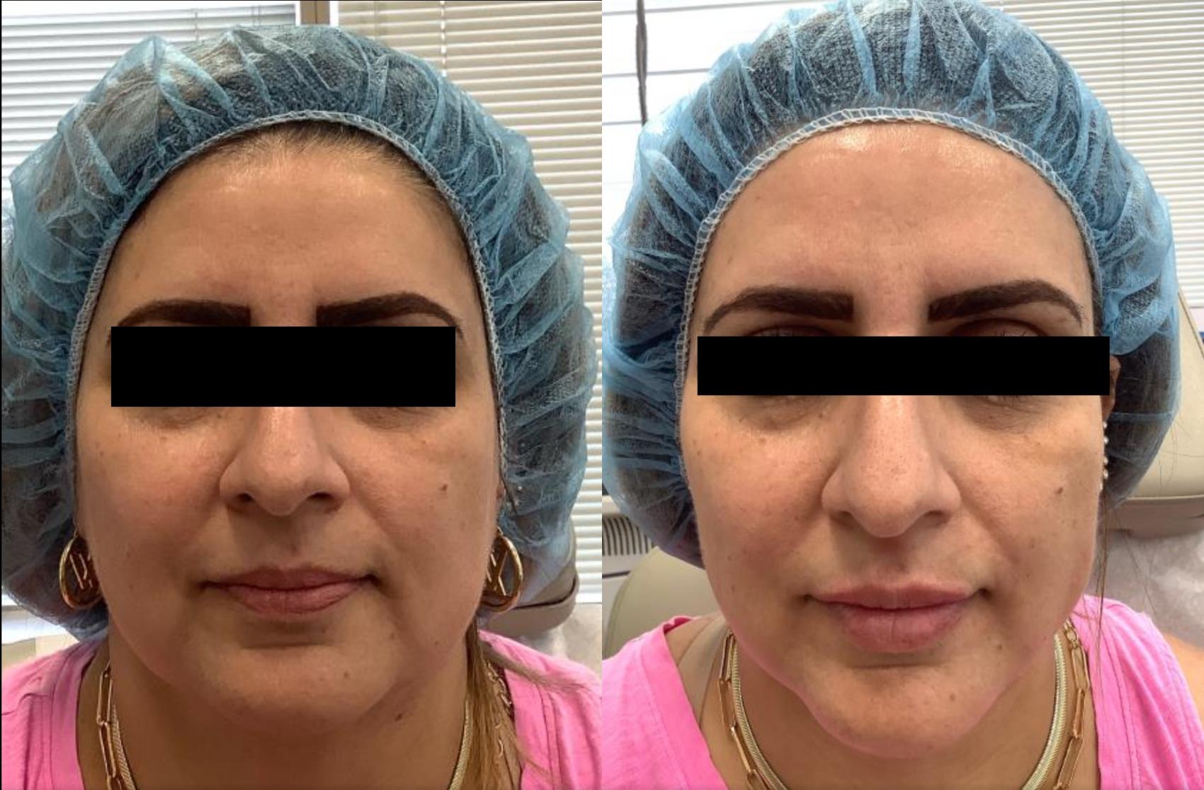 NOVA Thread Facelift Case 38 Before & After Front | Washington, DC | MI Skin Dermatology Center: Melda Isaac, MD