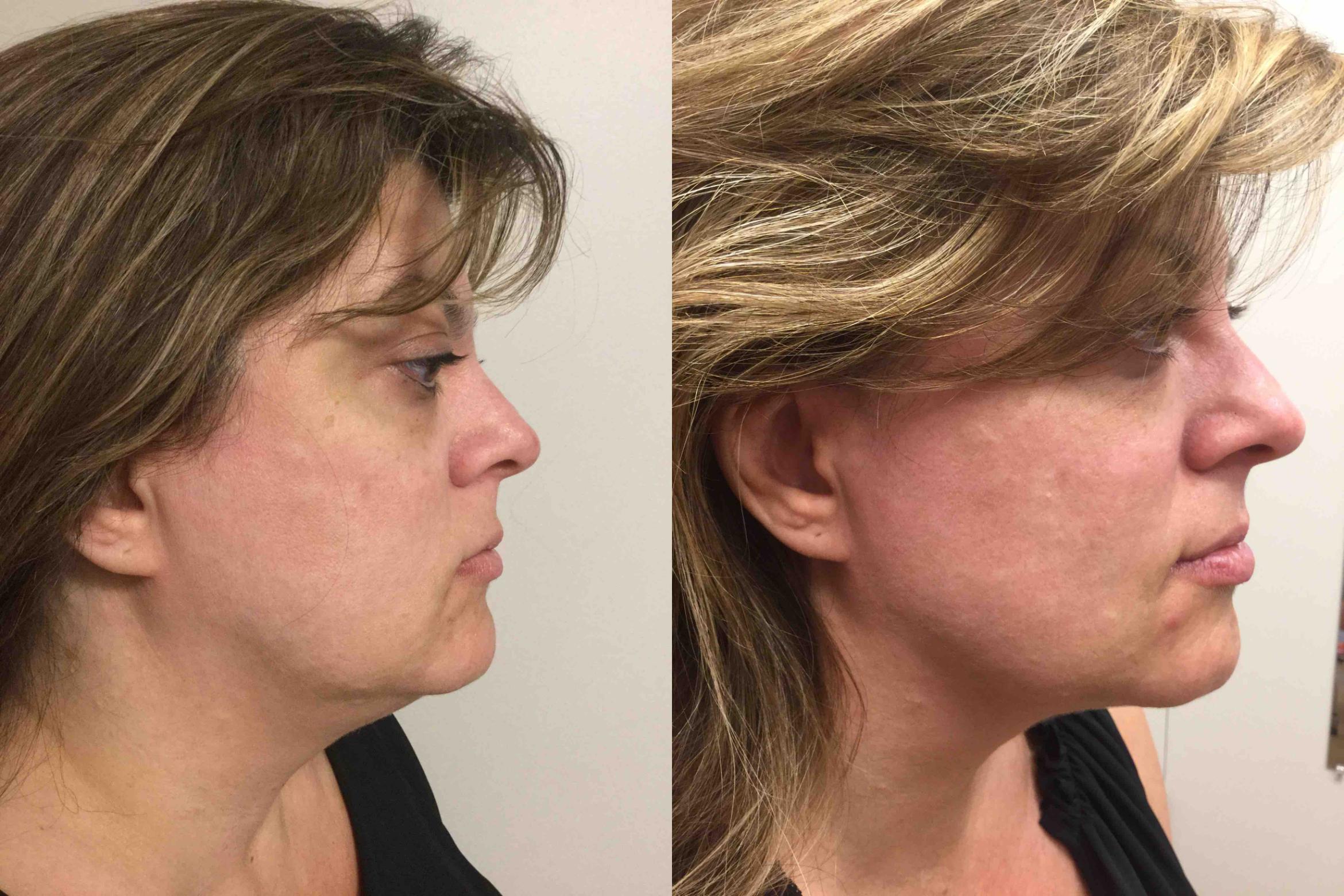 Before & After Photodynamic Therapy (PDT) Case 10 Right Side View in Washington, DC
