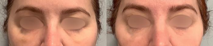 Before & After Tixel® Skin Rejuvenation Case 56 Front View in Washington, DC