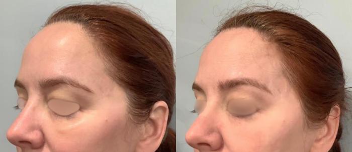 Before & After Tixel® Skin Rejuvenation Case 56 Left Oblique View in Washington, DC